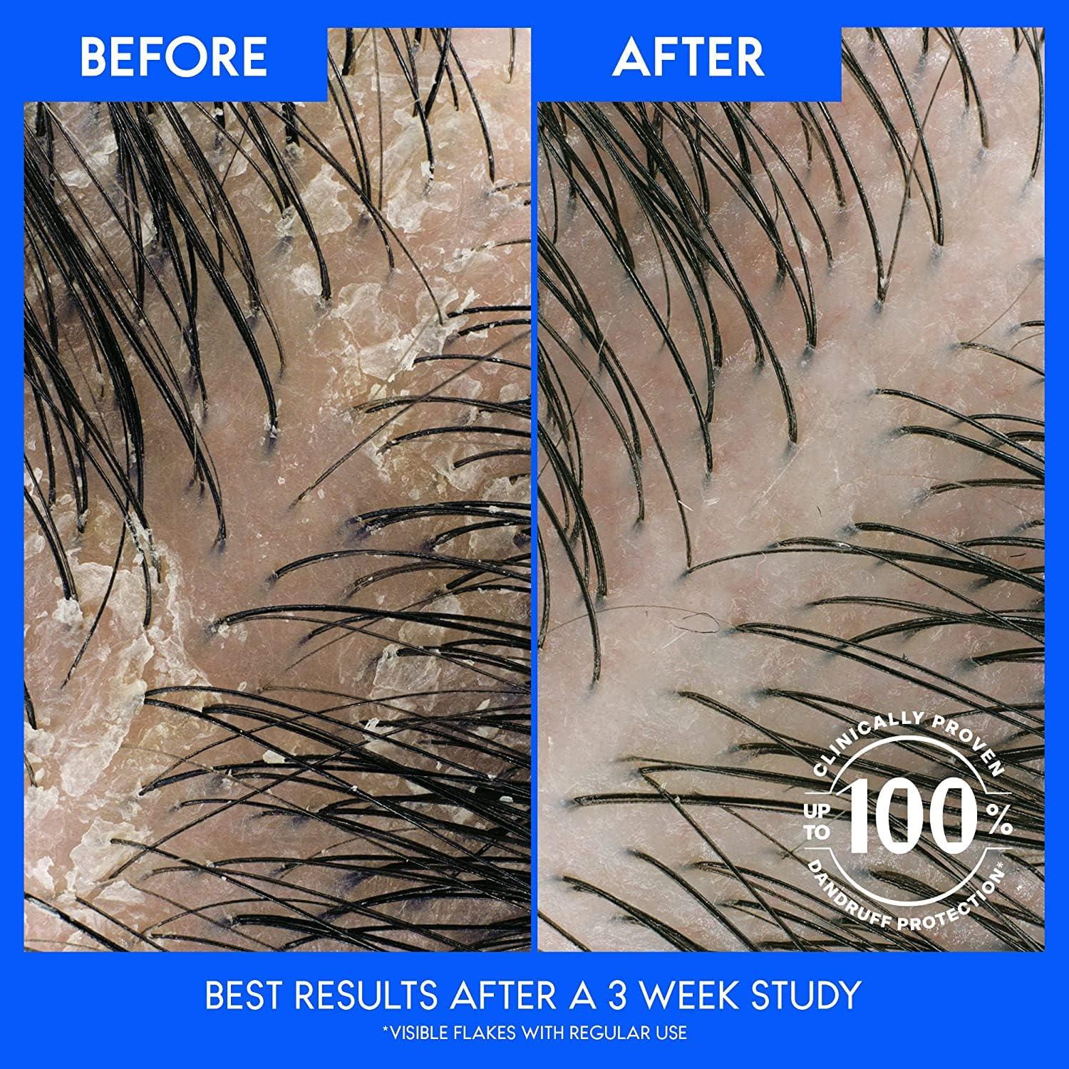 image:imageHead amp Shoulders AntiDandruff Shampoo with 1 Pyrithione Zinc Clinically Proven amp Scalp Care Treatment Fresh Green Apple Scent 321 Fl Oz Each 2 PackGreen Apple