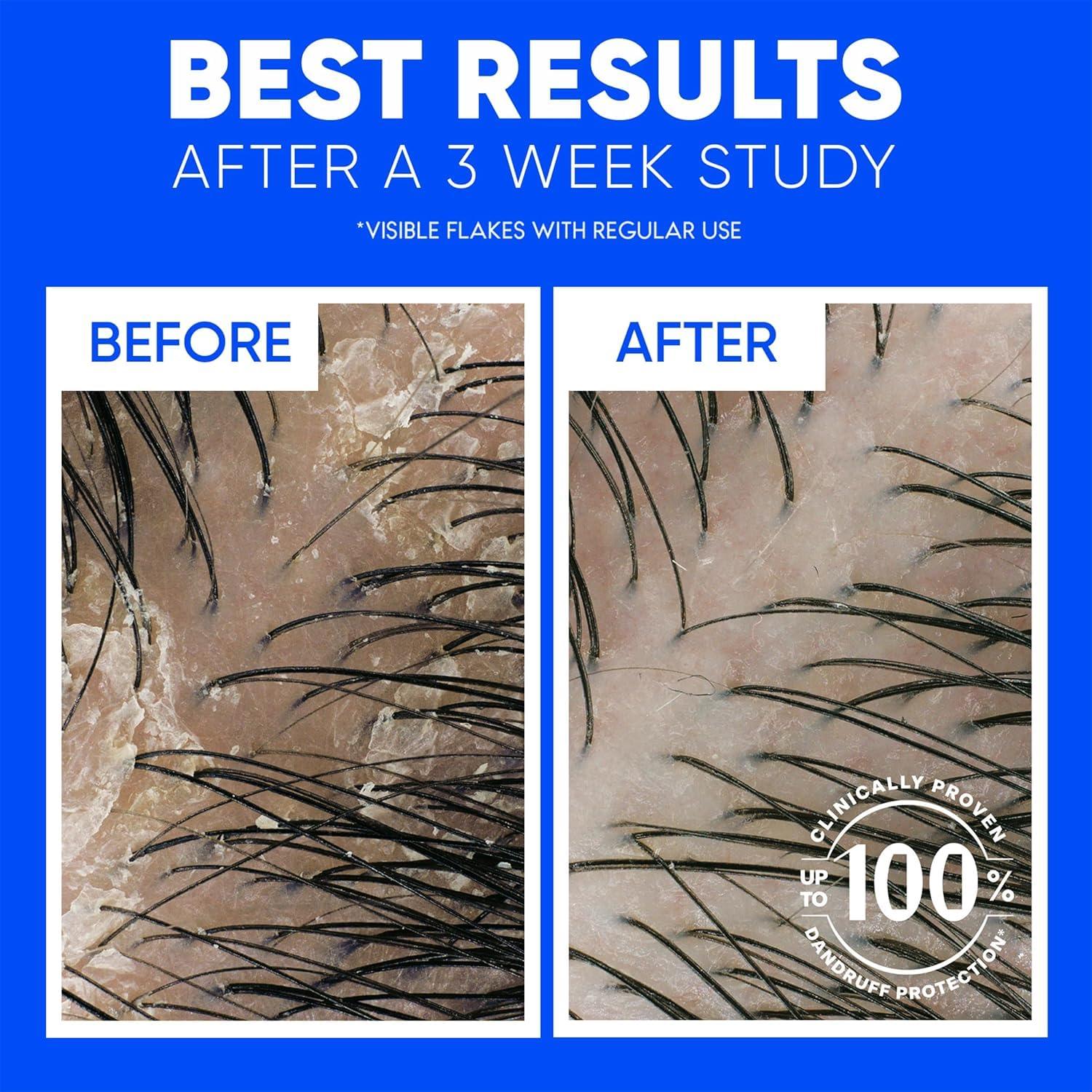 image:imageHead amp Shoulders AntiDandruff Shampoo with 1 Pyrithione Zinc Clinically Proven amp Scalp Care Treatment Fresh Green Apple Scent 321 Fl Oz Each 2 PackClassic Clean